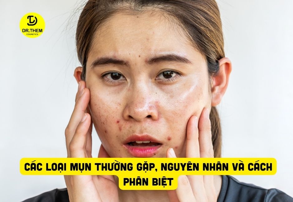 Các Loại Mụn Thường Gặp, Nguyên Nhân Và Cách Phân Biệt
