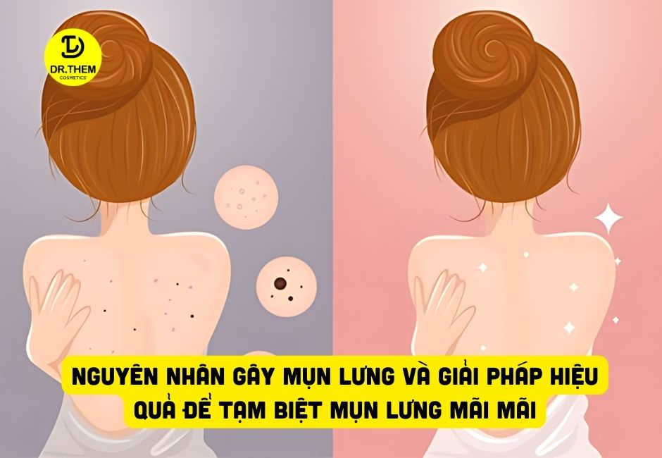 Nguyên Nhân gây Mụn Lưng và Giải Pháp Hiệu Quả Để Tạm Biệt Mụn Lưng Mãi Mãi